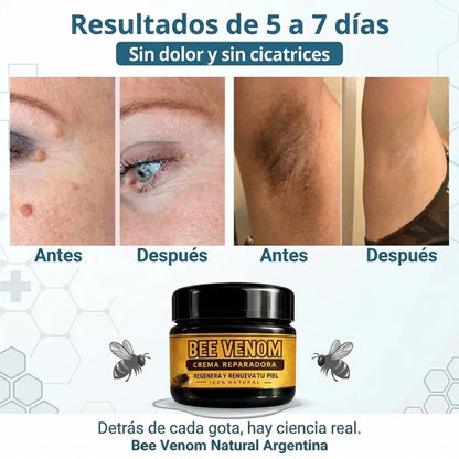 Bee venom -  Elimina Verrugas y Papilomas Desde Casa, Sin Dolor y sin que vuelvan