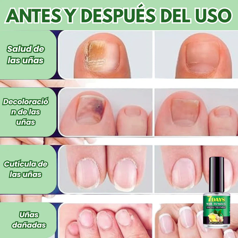 Uñas Libres en 7 Días