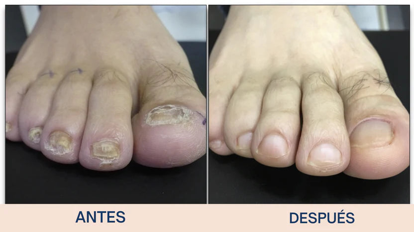 Uñas Libres en 7 Días