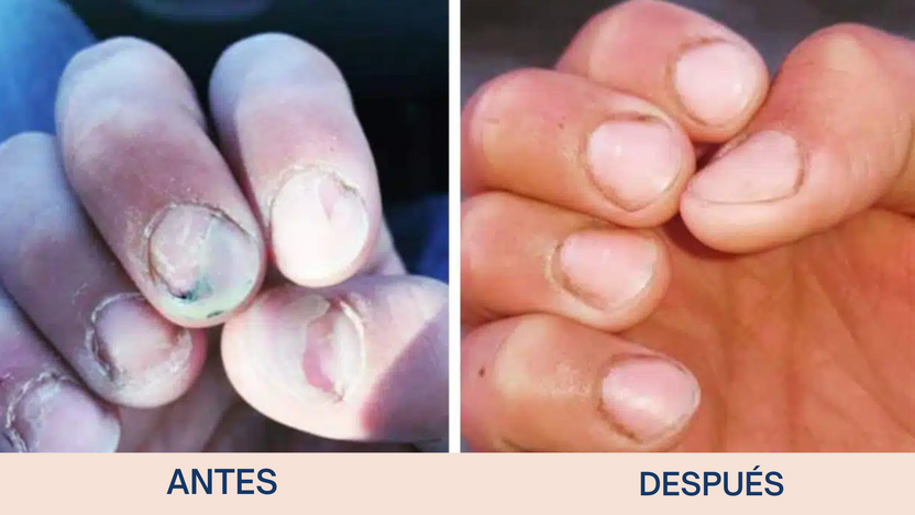 Uñas Libres en 7 Días