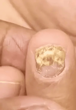 Uñas Libres en 7 Días